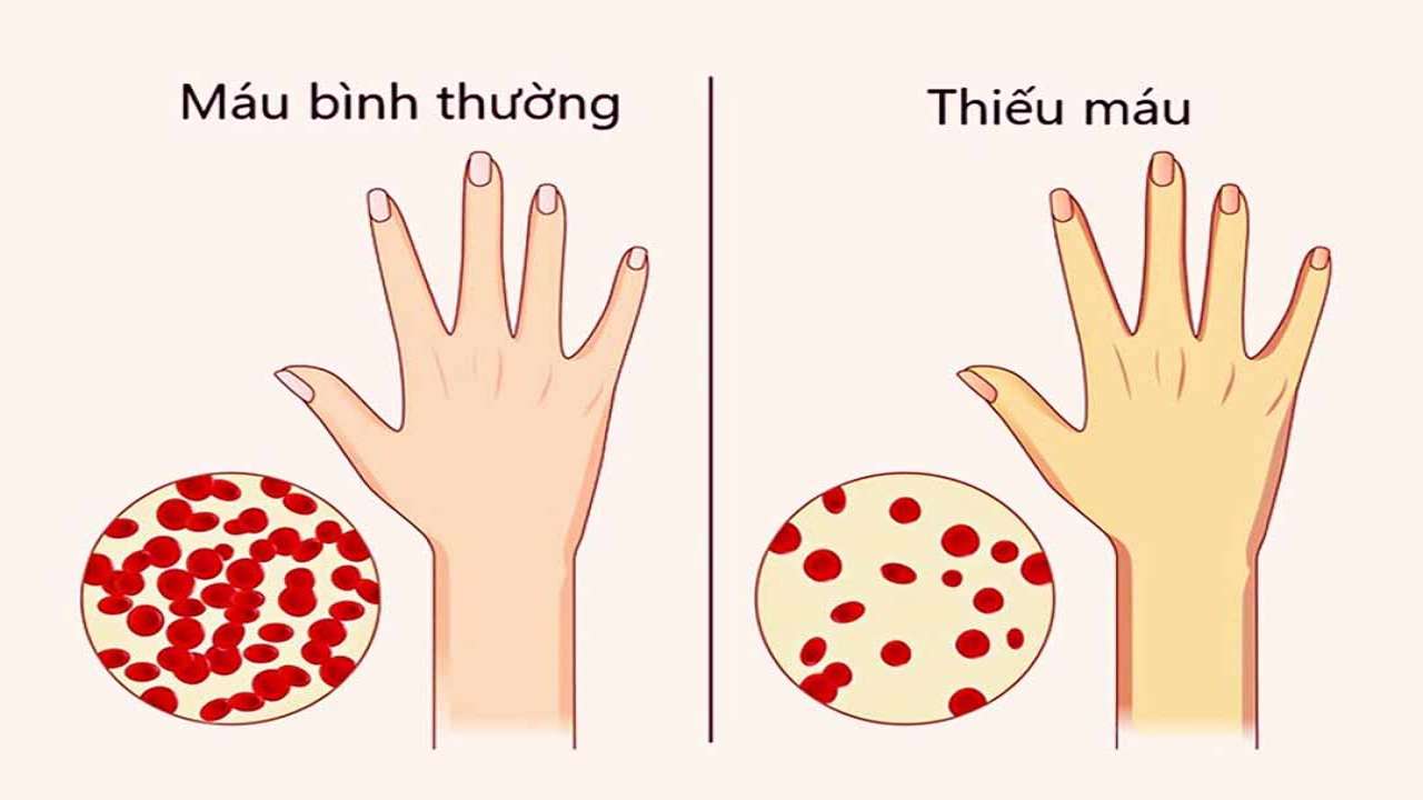 cac-loai-thieu-mau